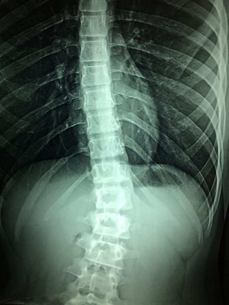 Image: Spinal cord X-Ray